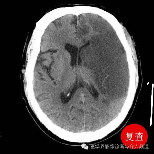 超急性期腦梗塞ct徵象