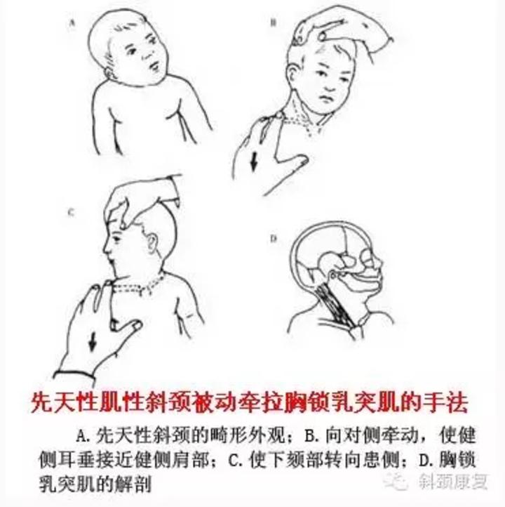 推荐全国各地治疗先天性肌性斜颈的好医生