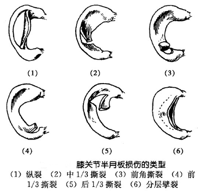 半月板破裂的类型包括:①纵裂,也称"桶柄样撕裂";②中1/3 撕裂,又名体