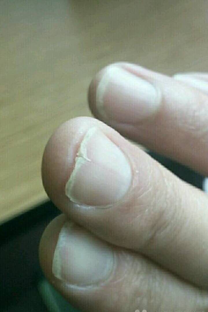 指甲竖纹或分叉,气血失畅之信号 - 微医(挂号网)