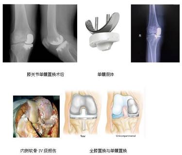 二沙岛医院骨科---关节外科专业组简介