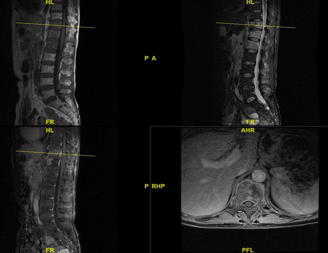 脊柱转移瘤胸椎图片