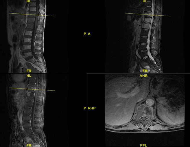 脊柱(胸椎)转移瘤的外科治疗复旦大学附属肿瘤医院神经外科脊柱肿瘤