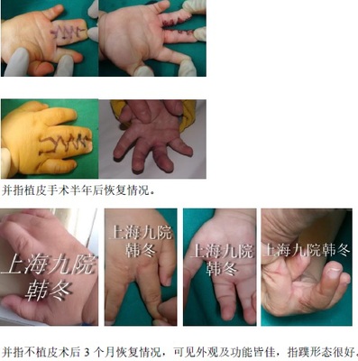 并指手术,究竟植不植皮?一个让千万家长纠结的问题