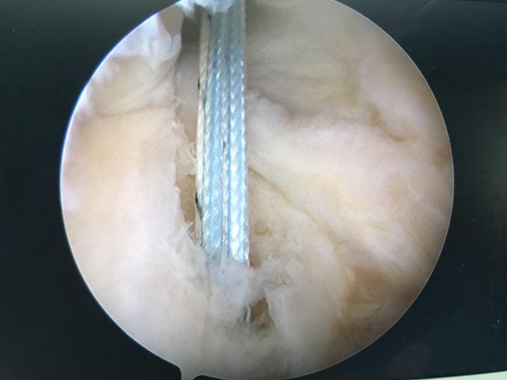 内侧半月板后根撕裂的缝合