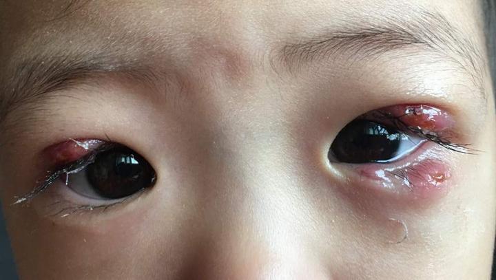 这些年被家长耽误的霰粒肿