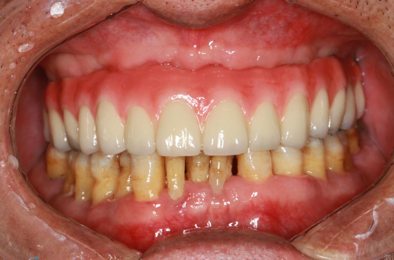 上半口即刻种植即刻修复