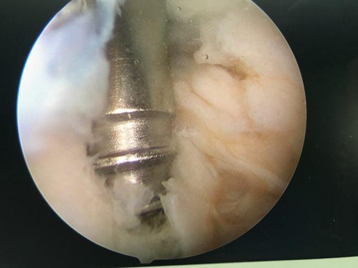 因为半月板后根的损伤是完全断裂,整个半月板后角是不稳定的,而且本身