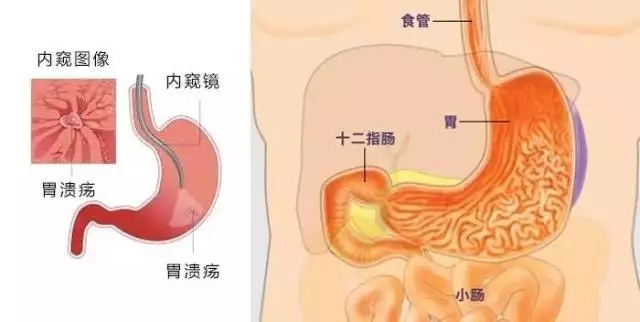 查胃病不做胃镜有方法（不做胃镜还有什么方法检查胃）