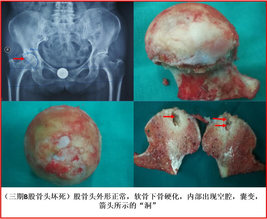 股骨頭壞死的外形分期