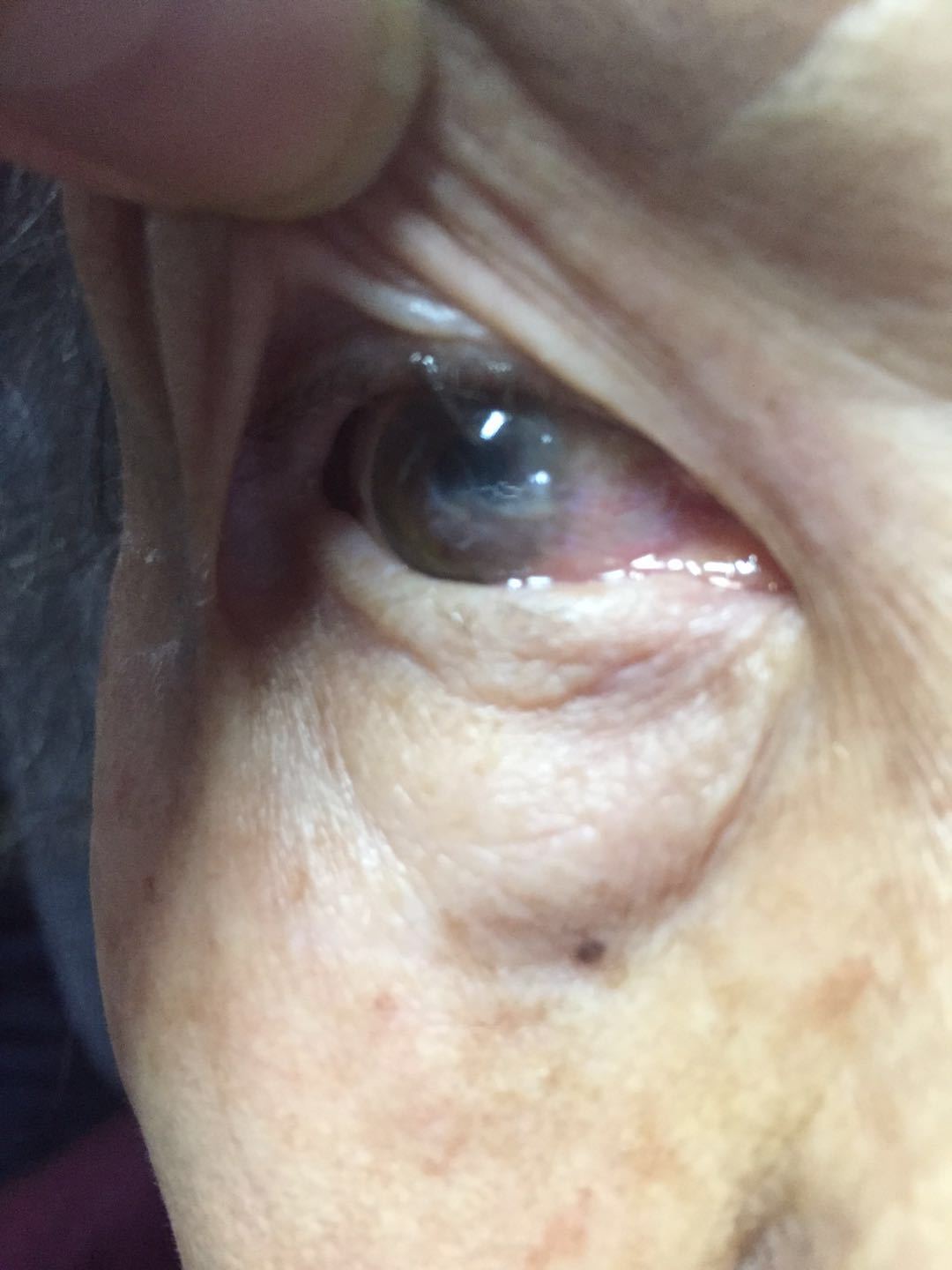 这些年那些被当作白内障的眼病(图)