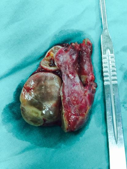 甲状腺多发乳头状癌并多发腺瘤1例