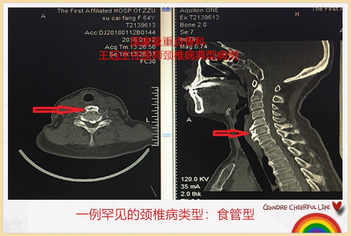 一例罕见的颈椎病类型食管型