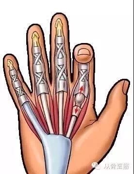 拇指腱鞘狭窄手术图解图片