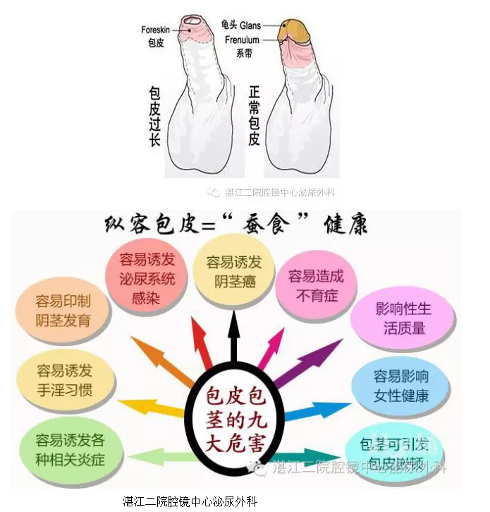 小儿包皮相关问题解决策略 - 湛江二院腔镜中心泌尿外