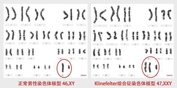 klinefelter综合征(克氏综合症又称原发小睾丸症或曲细精管发育不全)