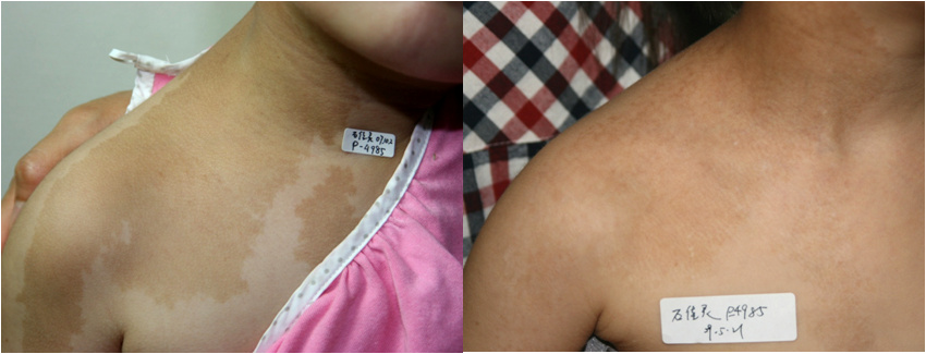 是一种先天性的皮肤表面的咖啡色斑记,大小和形状不一,边界清楚而色泽