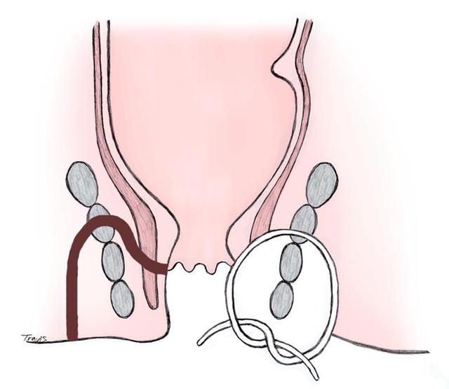 國內國外,肛瘻治療主張大不同!