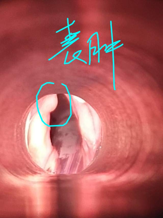 病案纪实声带囊肿