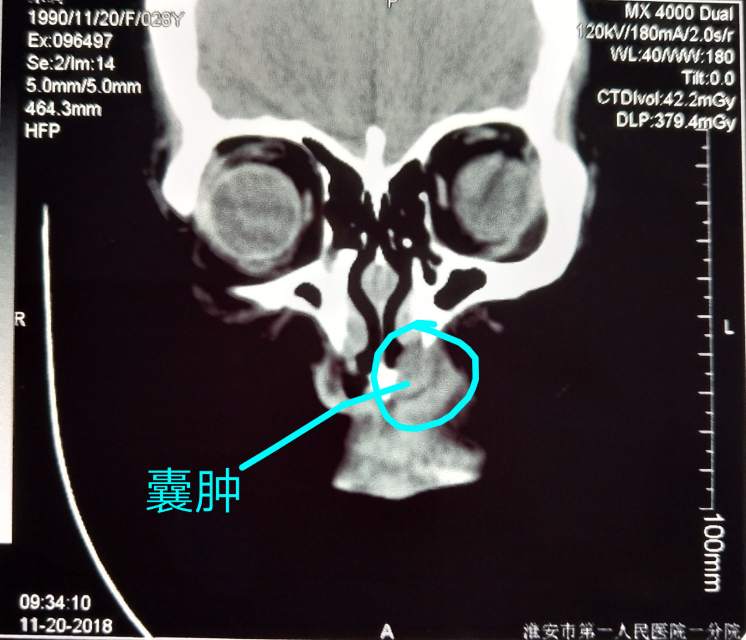 鼻前庭囊肿的症状图片图片