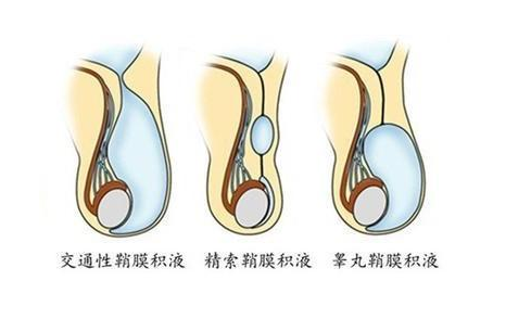 鞘膜是由浆膜构成的,分为脏,壁两层,脏的那一层跟睾丸的表面紧紧相贴