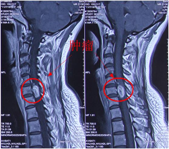 病例分享:成功全切10年病史患者高颈段神经鞘瘤