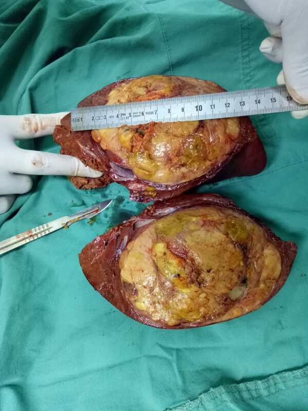 肝癌治疗系列六巨型肝癌的微创治疗