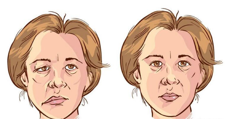 面瘫的治疗策略