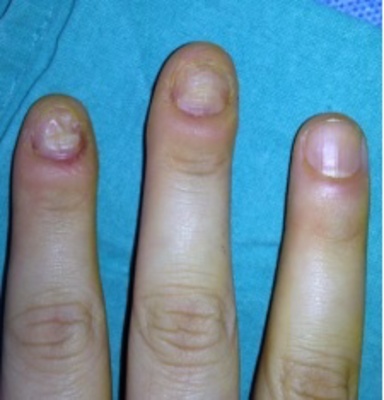 指甲咬变形怎么办?