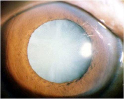 老年性白内障相关热门问题汇总