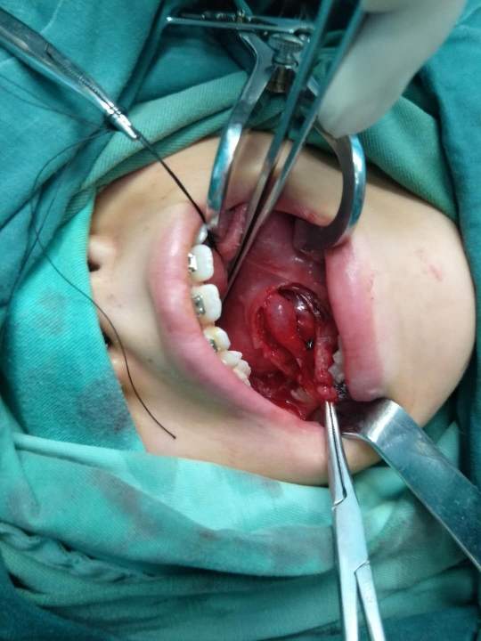 先天性颌下腺导管狭窄,手术分享.