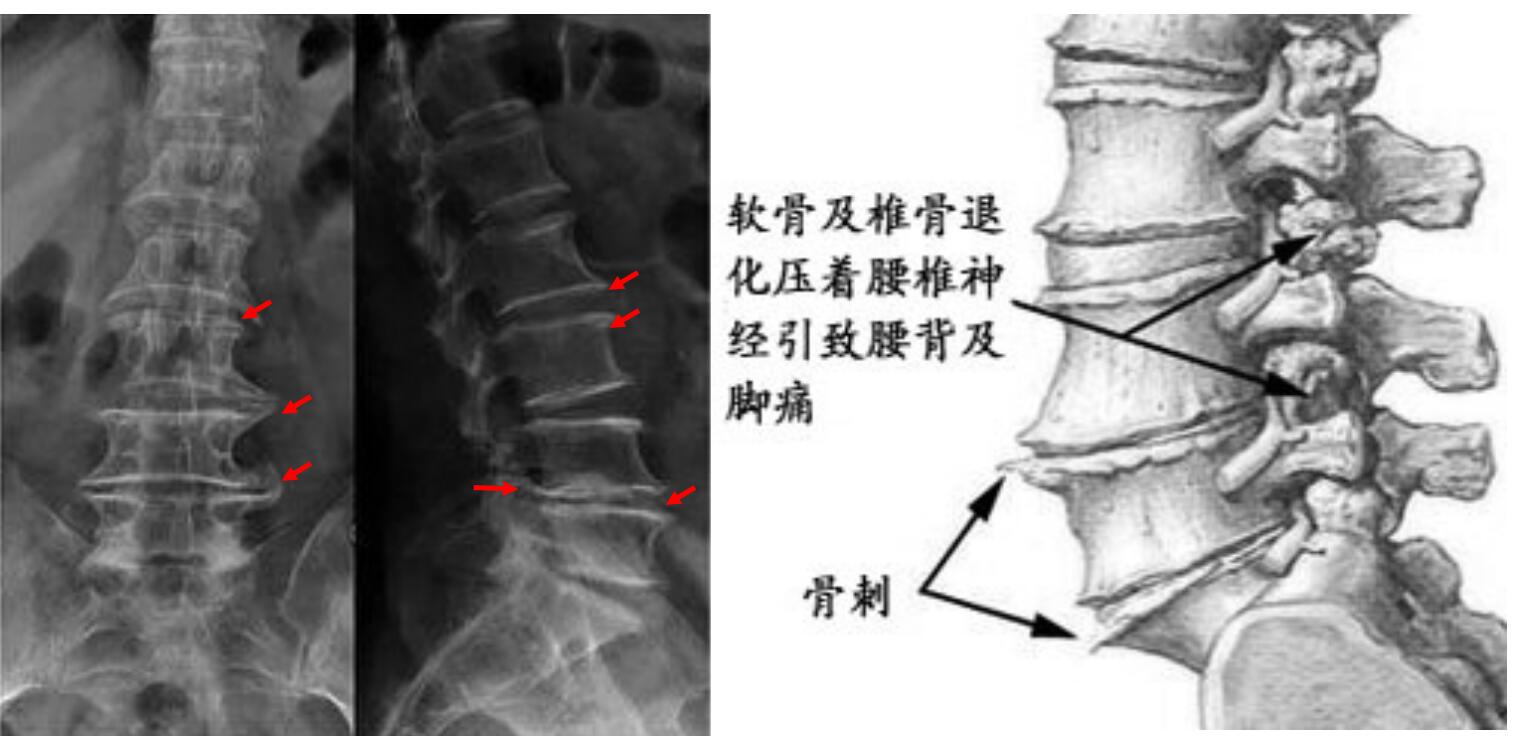 骨刺竟然是好东西?原来我们一直都错怪骨质增生了