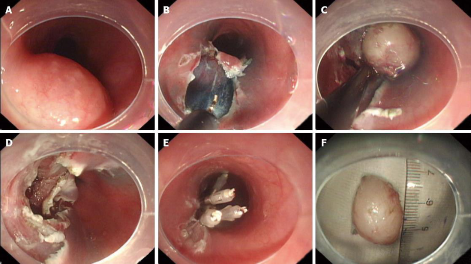 内镜下esd切除粘膜下肿物病例介绍