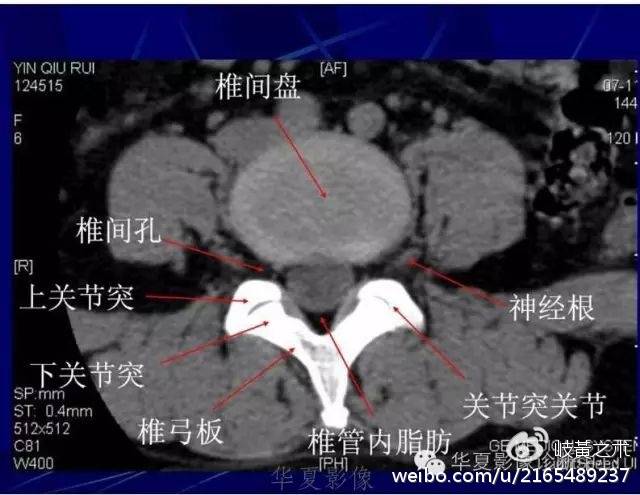 腰突的原理_白领司机腰突真的可以治愈么