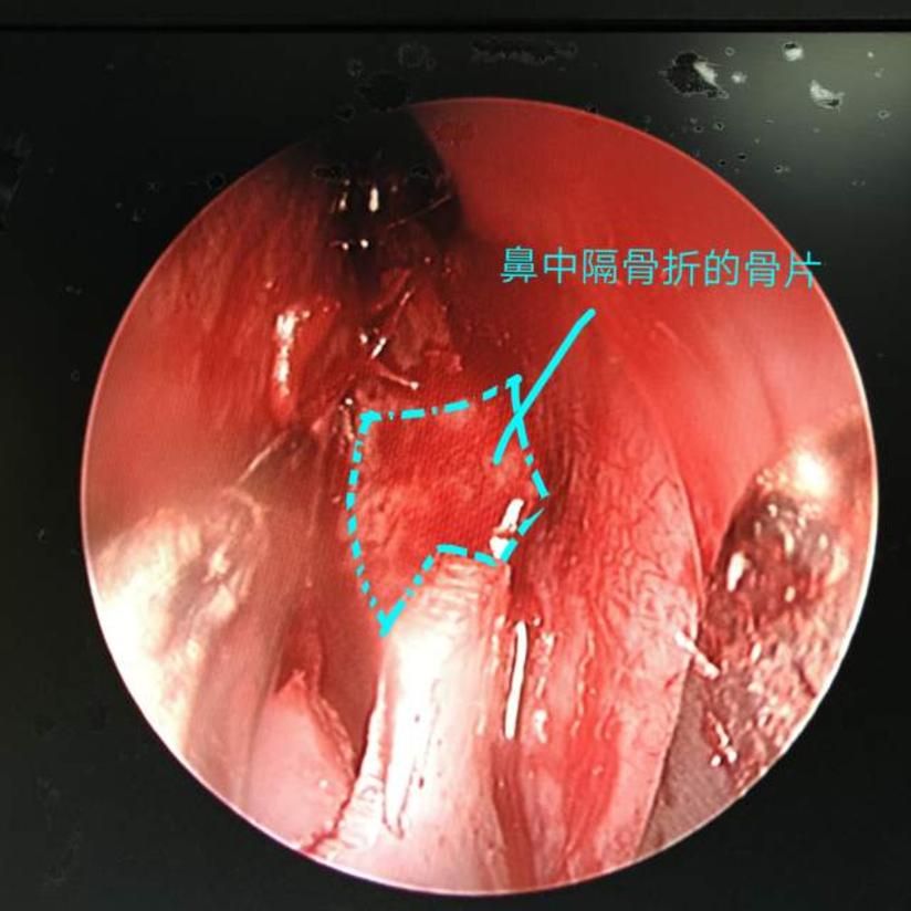 病案纪实 鼻骨联合鼻中隔骨折 健康号 微医