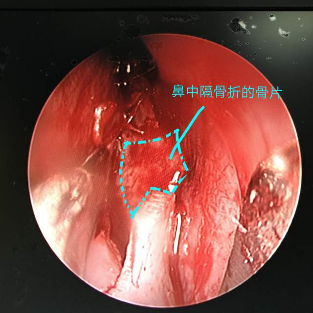 时被肘部撞伤鼻部一天"入院,鼻骨三维重建ct: 左侧鼻骨骨折伴有移位