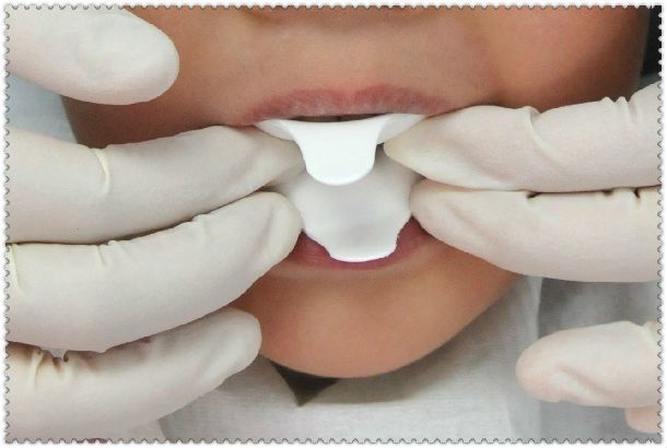 氟化泡沫预防乳牙龋齿