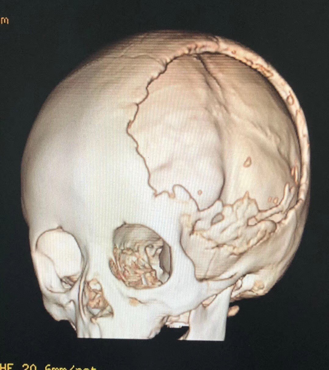儿童颅骨缺损的手术治疗(颅骨修补术)_王举磊医生文章_唐都医院-微医