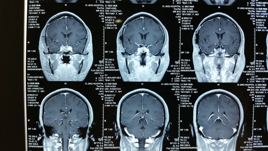 垂体瘤的微创治疗