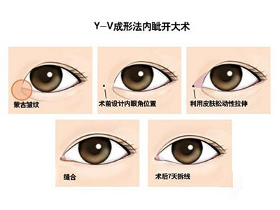 开眼角(目眦)手术前后注意事项