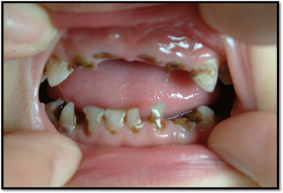 含着奶头睡觉牙齿就这样烂掉了