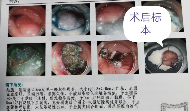 结直肠癌术后患者定期复查肠镜到底有多重要
