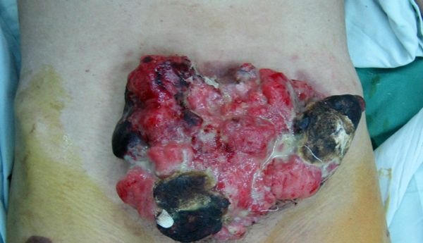 常见腹壁肿瘤一二