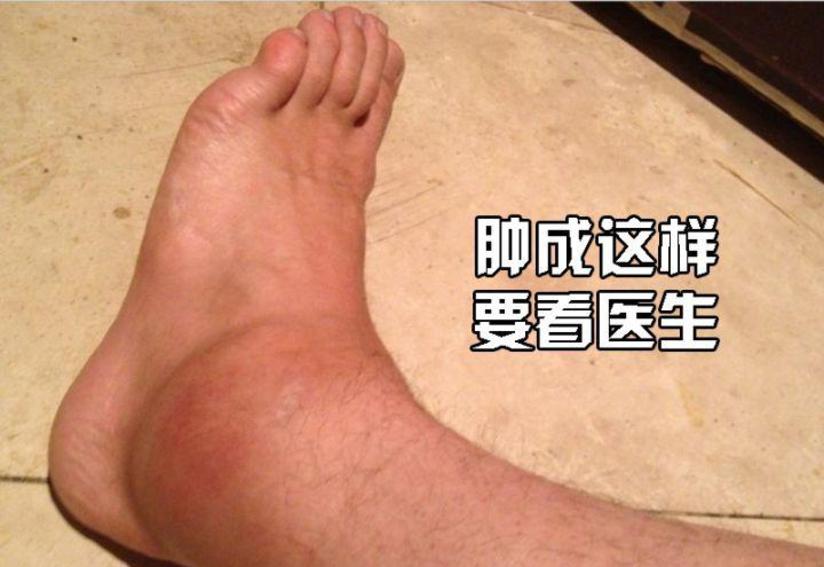 脚踝扭伤成习惯 可就真的伤不起 健康号 微医