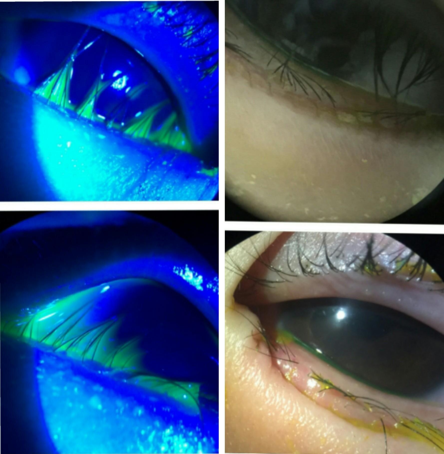 儿童倒睫以内侧为主,而