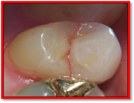 牙齿隐裂示意图