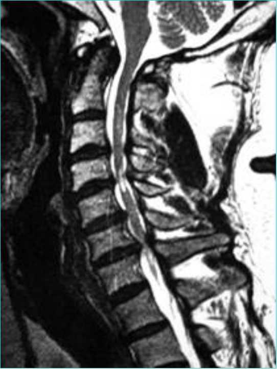上肢肩背部僵硬麻木疼痛萎缩是什么病--神经根