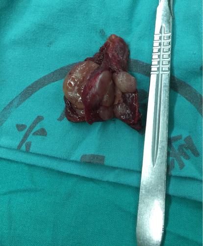 女,46岁,超声提示两侧多个滤泡性肿瘤,可疑乳头癌.