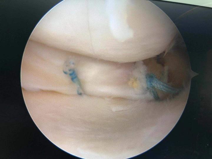 因为半月板后根的损伤是完全断裂,整个半月板后角是不稳定的,而且本身