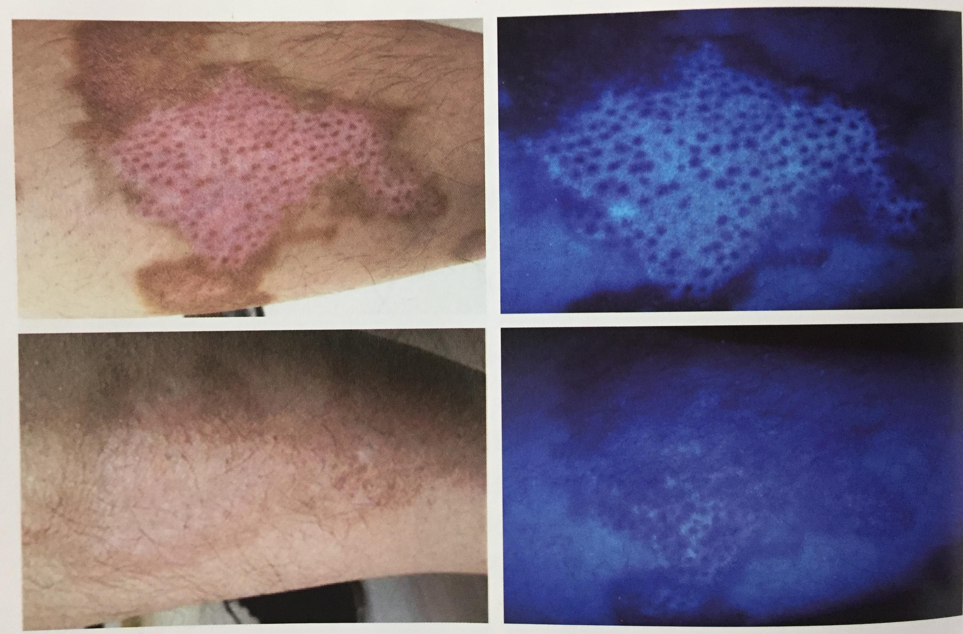 161丨白癜风的照妖镜伍德灯